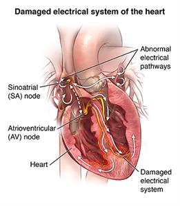 Damaged electrical system of the heart